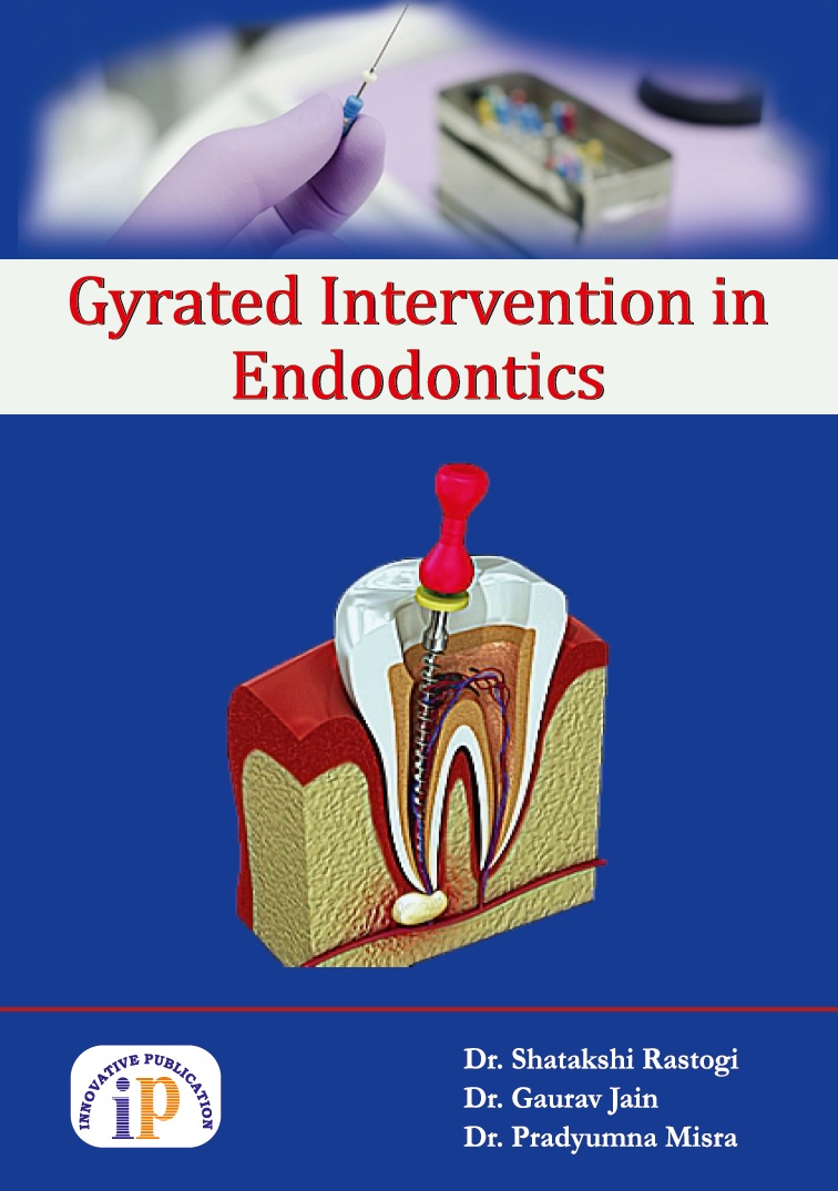 Gyrated Intervention in Endodontics